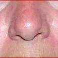 Фото - /konjak/55-kak-ubrat-allergicheskie-simptomy-na-alkogol.html